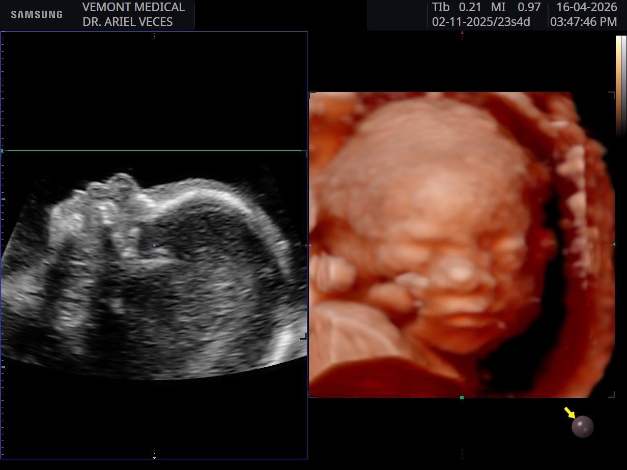 Ultrasonido 4D y 2D de bebé realizado por el Dr. Ariel Jesús Veces en VEMONT Medical