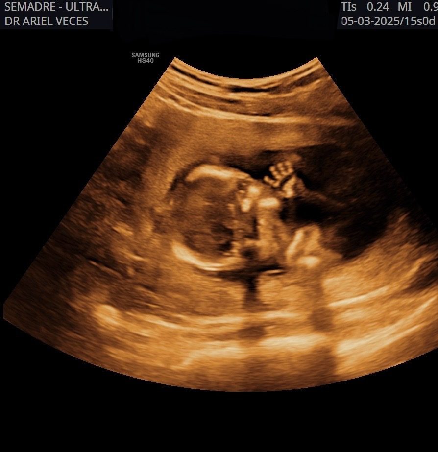 Ultrasonido obstétrico mostrando la manita del bebé, realizado por el Dr. Ariel Jesús Veces